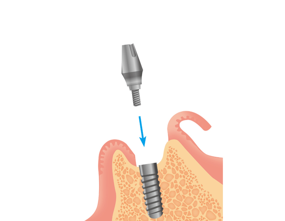 アバットメントの装着