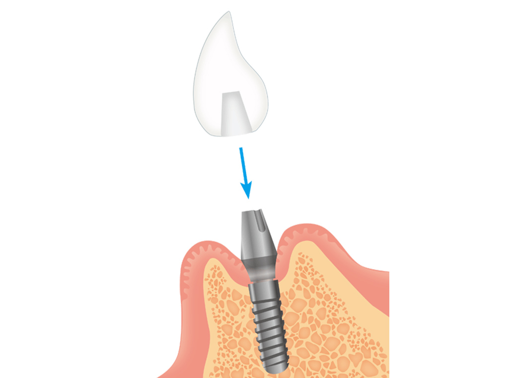 人工歯の製作、仮歯の装着