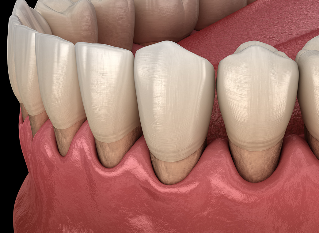 インプラント周囲炎