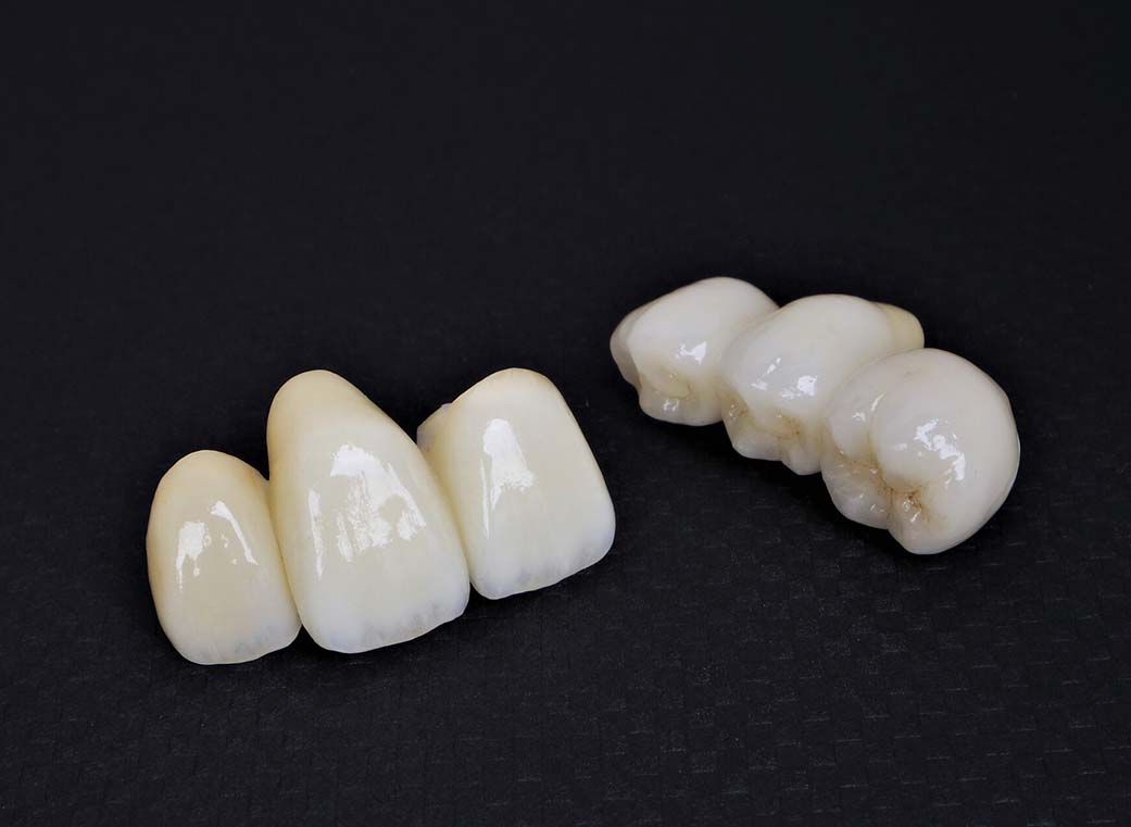 オールセラミック