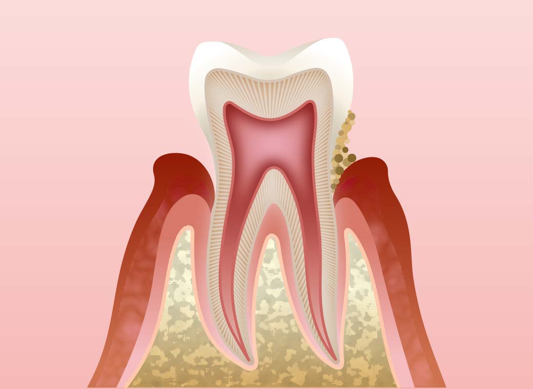 歯周炎（軽度）