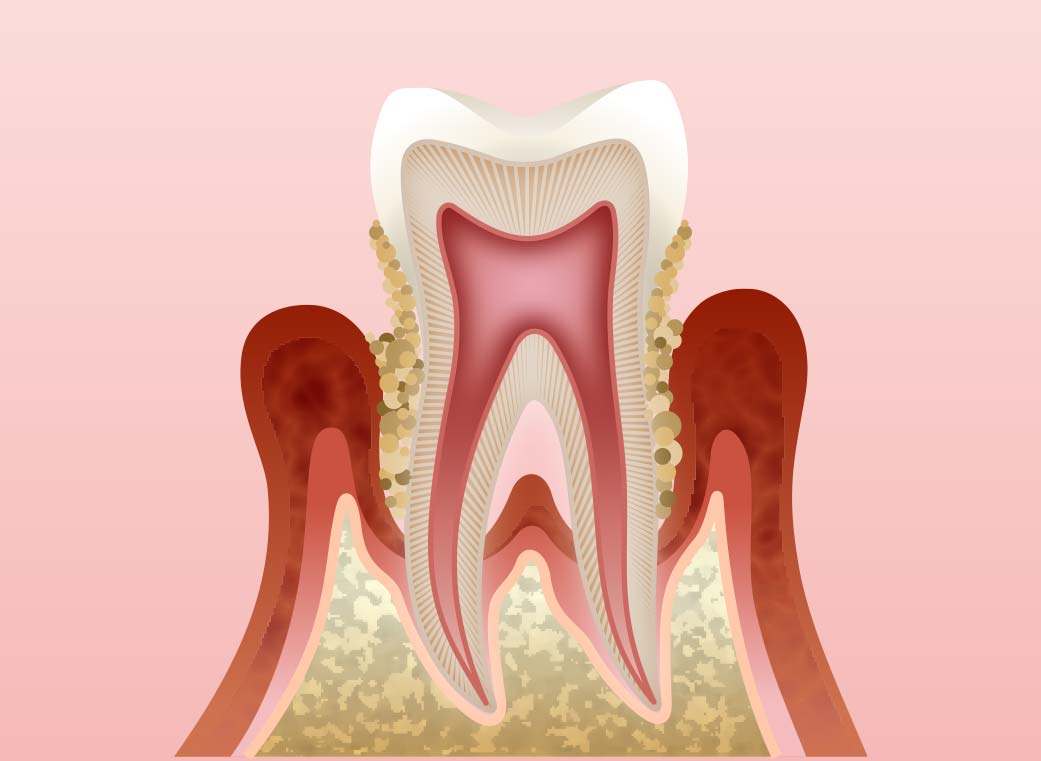 歯周炎（中等度）