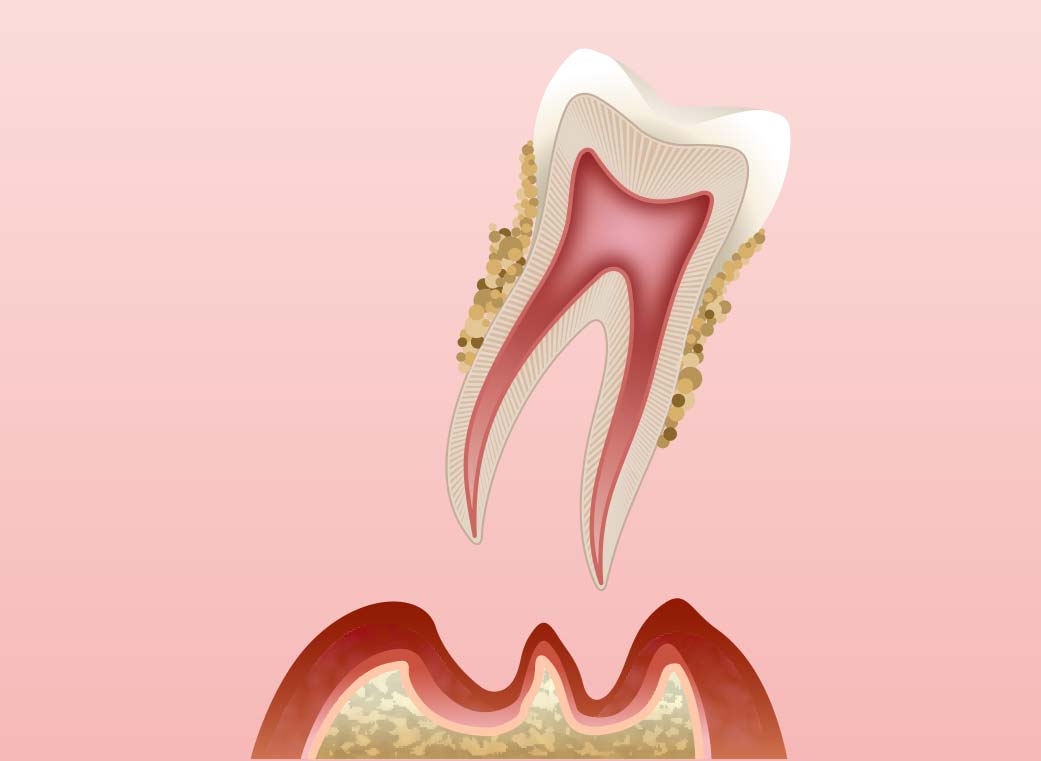 歯周炎（重度）
