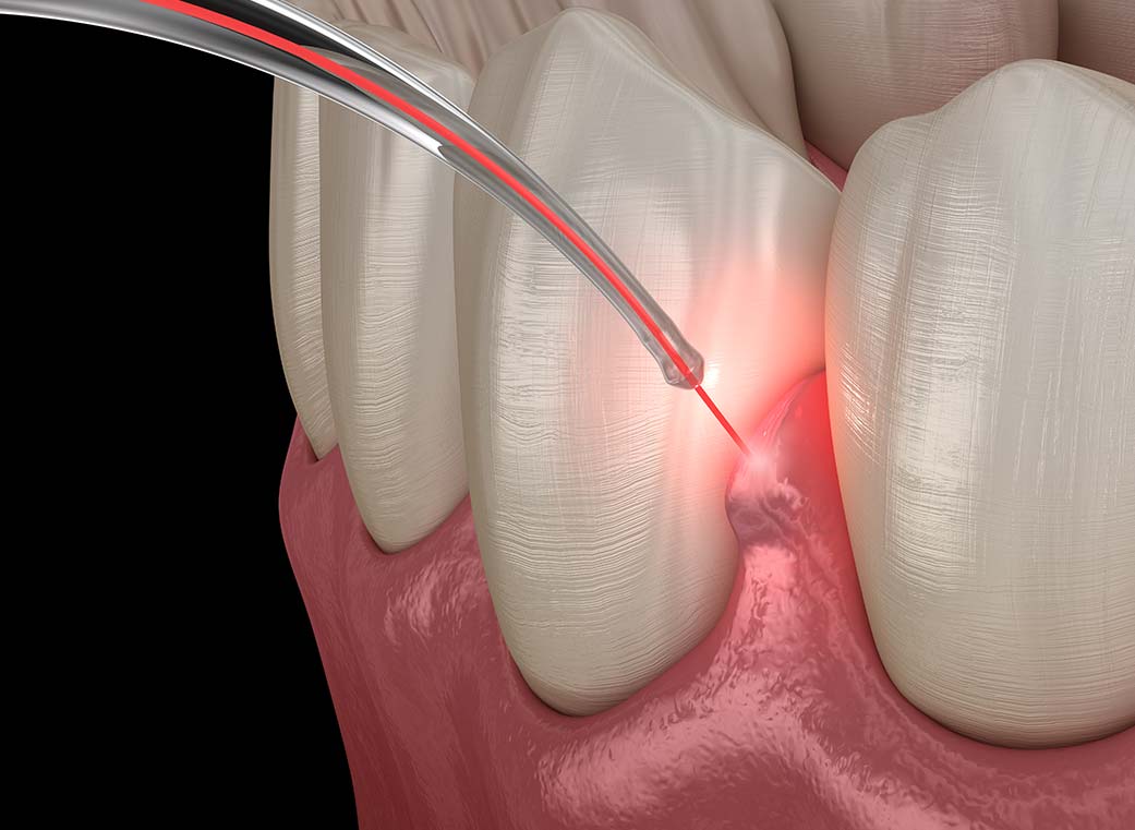 進行した歯周病の治療
