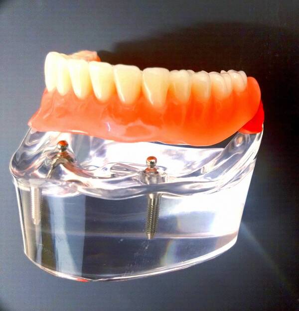 インプラント義歯(インプラントオーバーデンチャー)について